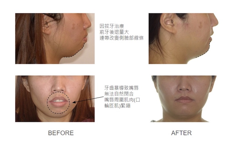 隱適美暴牙矯正前後臉型與嘴唇變化:拔牙矯正前牙後退量大,連帶改變臉部線條;原本暴牙導致嘴唇無法自然閉合,矯正後可自然閉合
