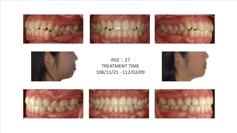 隱適美骨性暴牙矯正前後臉型及咬合變化比較,上排前牙後退也解決下嘴唇外翻