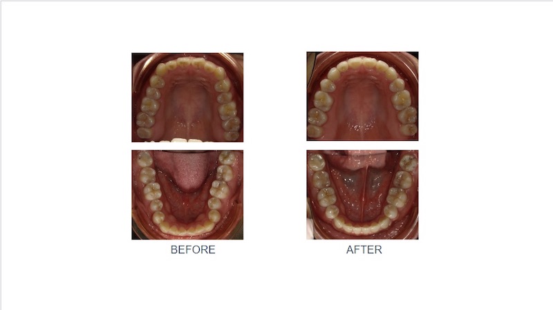 隱適美骨性暴牙矯正前後上下排牙弓形狀變化：矯正前上排前牙角度比較外飛且下排有輕微擁擠；拔四顆小臼齒矯正後，牙齒後退排整齊，擴大牙弓呈現理想的圓滑形狀