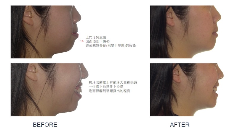 隱適美骨性暴牙矯正前後臉型與嘴唇變化:矯正前上門牙角度飛而頂到下嘴唇,造成嘴唇外翻(視覺上變厚)的假象;拔四顆小臼齒矯正大量後退前牙並往上拉提,影響牙齦露出的程度,矯正後嘴唇外觀回復正常
