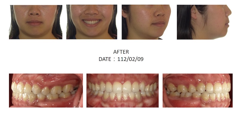 隱適美骨性暴牙矯正後的各角度臉型及咬合近照，牙齒角度內縮排整齊進而改善側臉輪廓