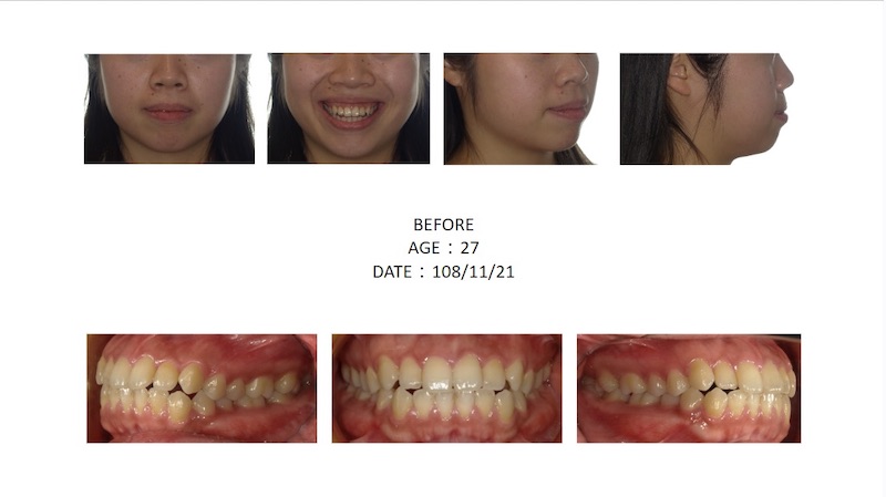 隱適美骨性暴牙矯正前的各角度臉型及咬合近照,上門牙角度較外飛造成下唇外翻錯覺