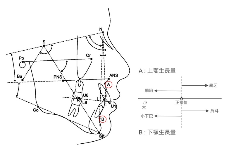 側顱X光片(Cepha)的AB測量點示意圖,定位出上顎骨和下顎骨過多的量