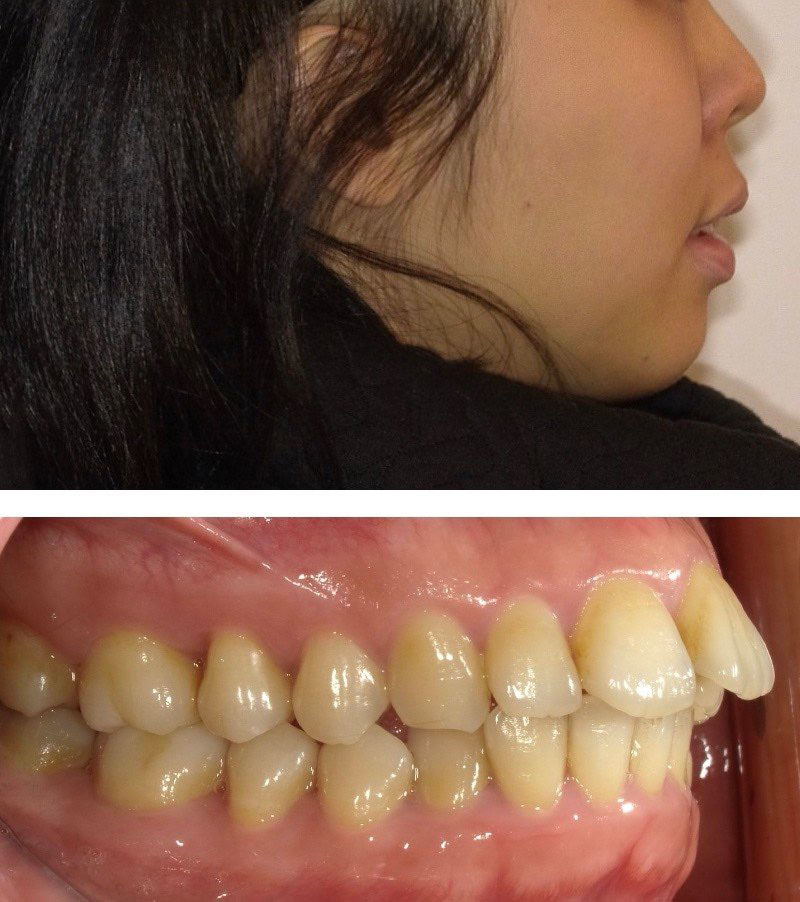 暴牙案例1:單純齒性暴牙