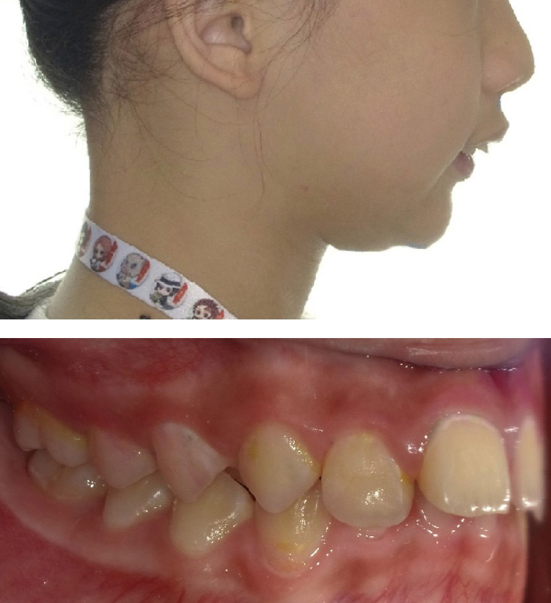 暴牙案例2:假骨性真齒性暴牙