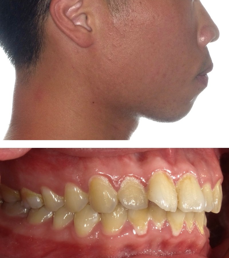 暴牙案例3:單純骨性暴牙 + 一點點齒性暴牙