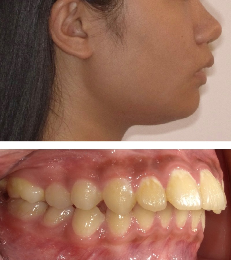 暴牙案例4:骨性暴牙 + 上顎齒性暴牙