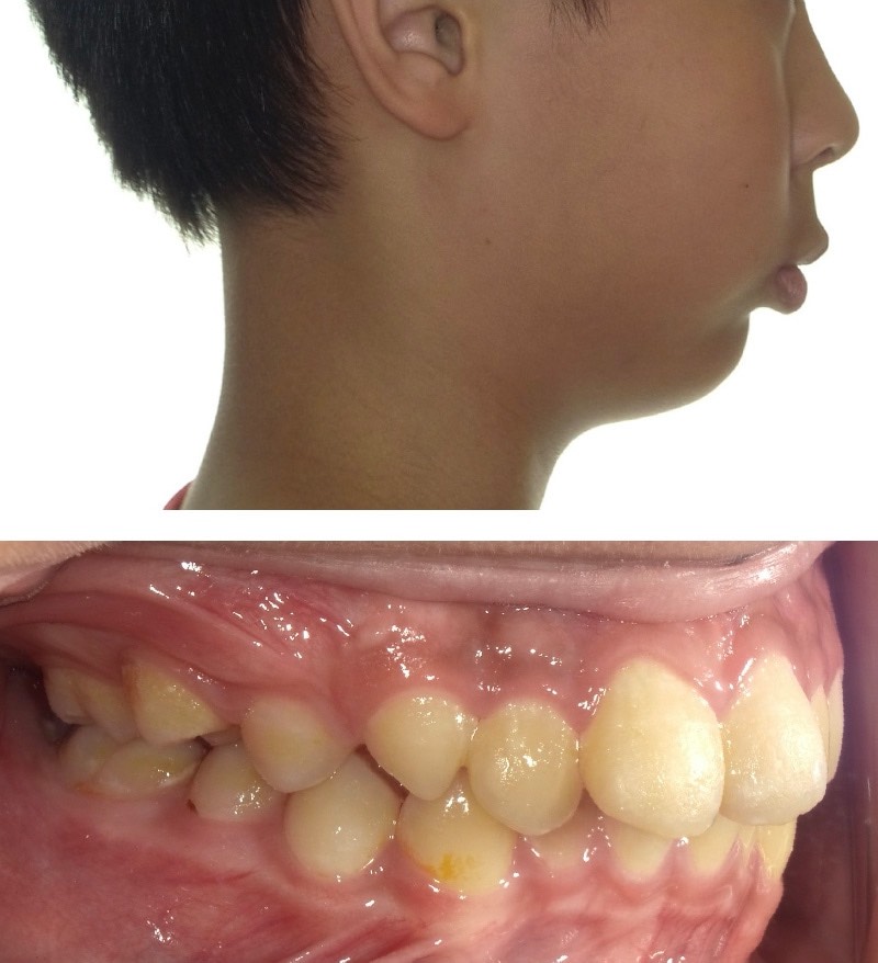 暴牙案例5a:骨性下顎太少,會覺得上面暴牙