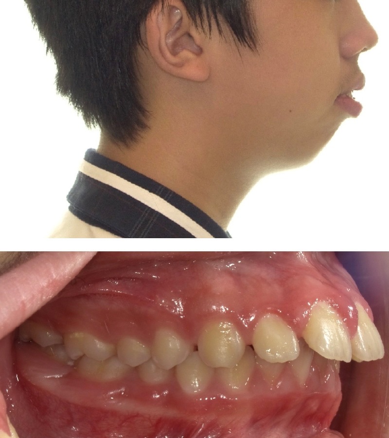 暴牙案例5b:小下巴但臉型更暴