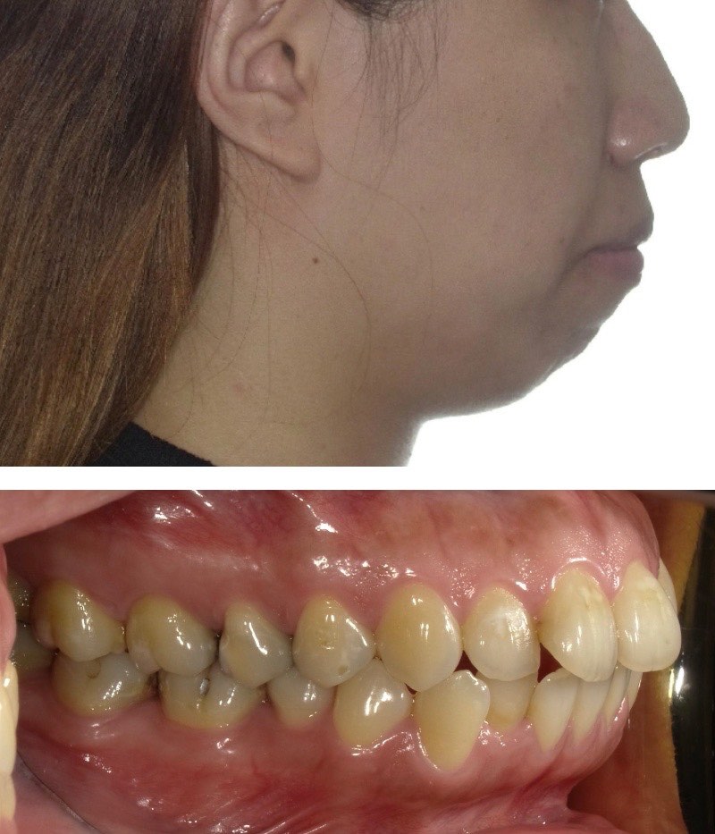 暴牙案例6a:嚴重骨性暴牙 + 下臉部開展角度(下巴後旋)