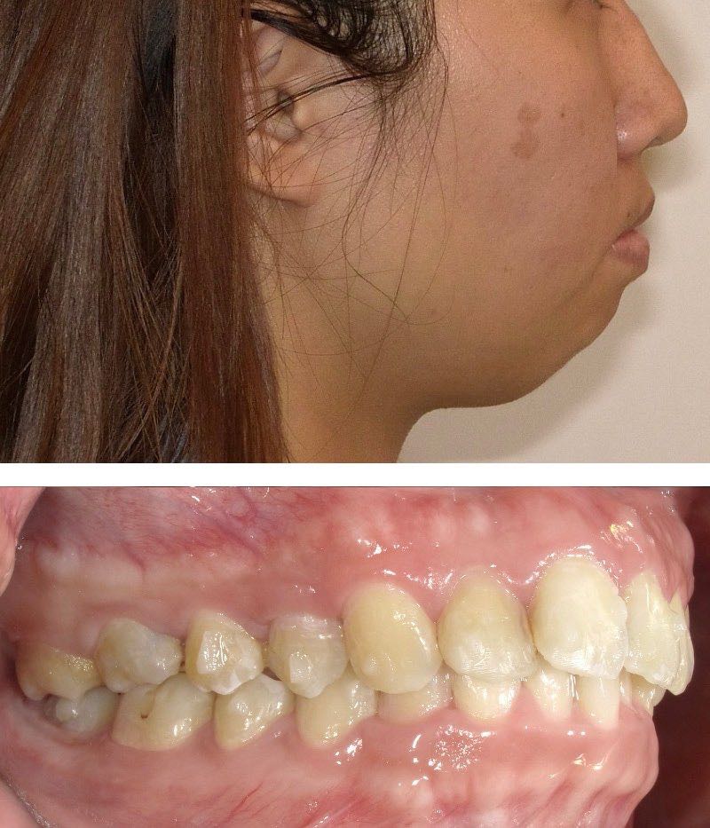 暴牙案例6b:嚴重骨性暴牙 + 下臉部開展角度(下巴後旋)