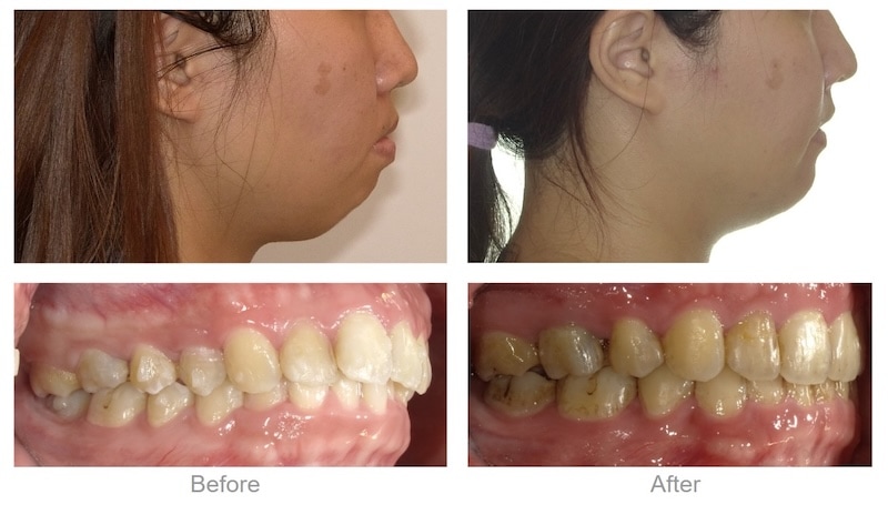 骨性+齒性暴牙透過拔牙與骨釘矯正前後對比,下巴逆時針旋轉變得更加明顯且立體