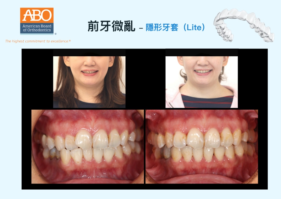 前牙微亂採隱適美Lite矯正前後臉型及咬合變化對比