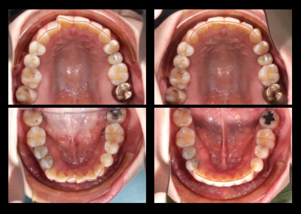 隱適美Lite矯正前後上下牙弓變化,前牙弧度從凌亂轉為圓滑U型牙弓
