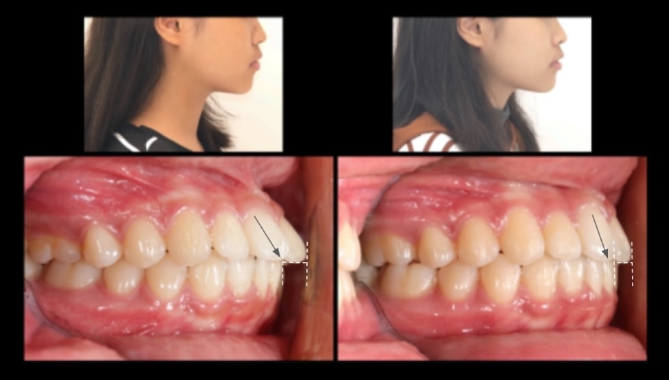 牙齒矯正前後側臉與側面咬合變化對比,拉直前牙角度並收攏下排凸出犬齒