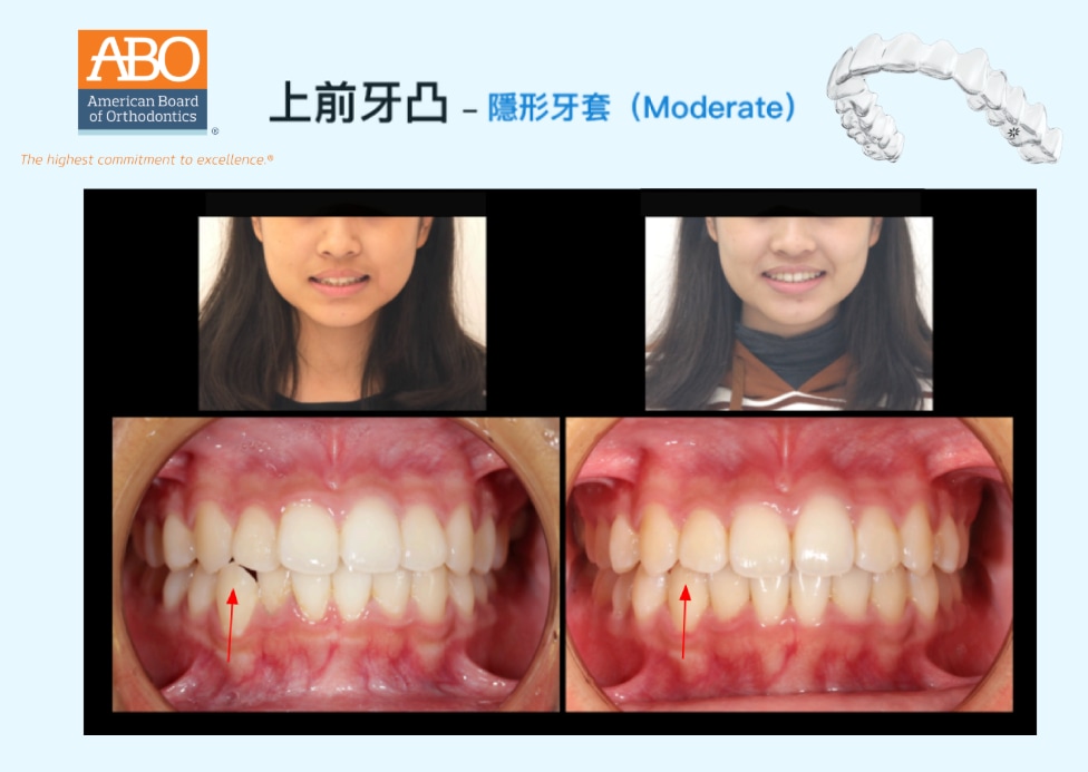 上前牙凸採隱適美矯正前後臉型及正面咬合變化對比,改善前牙突出與排列角度