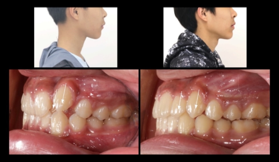 不拔牙矯正前後側臉與側面咬合變化對比,改善上側門牙與高位犬齒排列