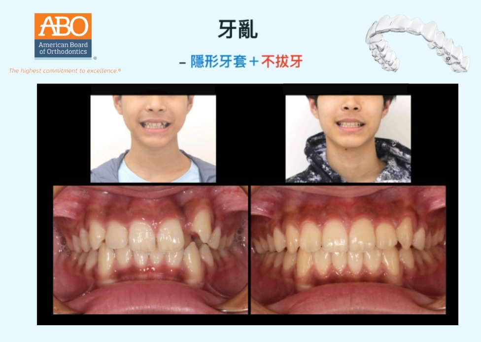 牙齒擁擠採不拔牙矯正,前後臉型與咬合對比顯示排列與美觀同步改善