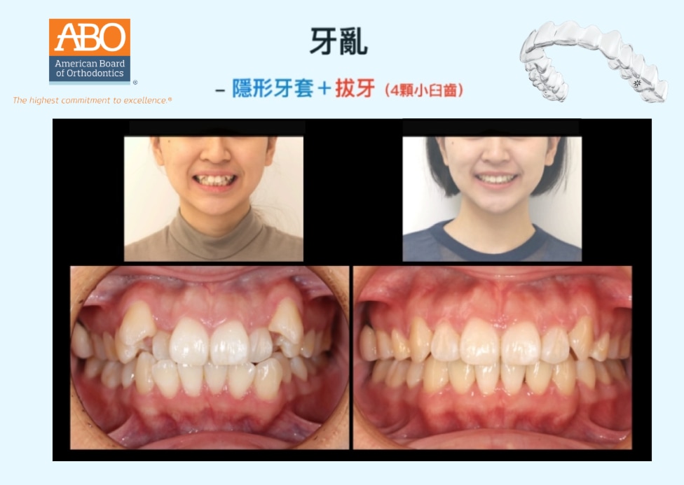 牙齒凌亂採拔牙矯正前後臉型與咬合變化對比,改善牙齒亂、高犬齒與中線偏移等問題