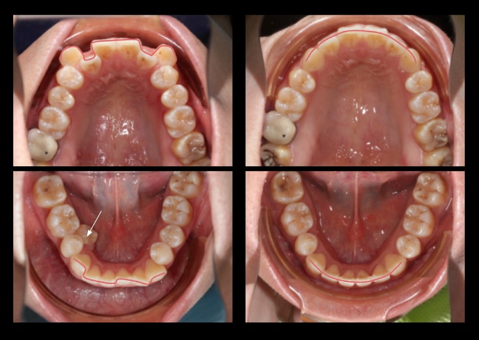 拔牙矯正前後上下牙弓變化,解決上排高犬齒與右下牙齒內縮,牙弓排列整齊