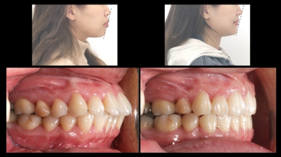 拔牙矯正前後側臉與側面咬合變化,前牙後退改善嘴唇凸,臉型更協調自然
