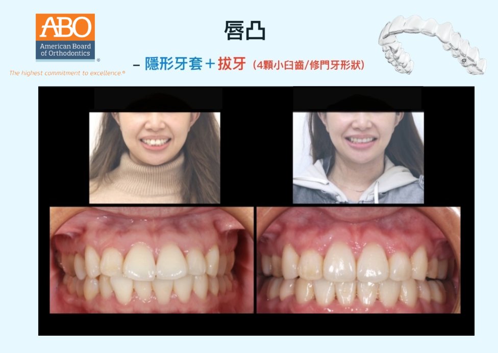 採拔牙矯正與牙齒形狀修整前後對比,改善嘴唇凸、牙齒凌亂,門牙形狀比例更加協調