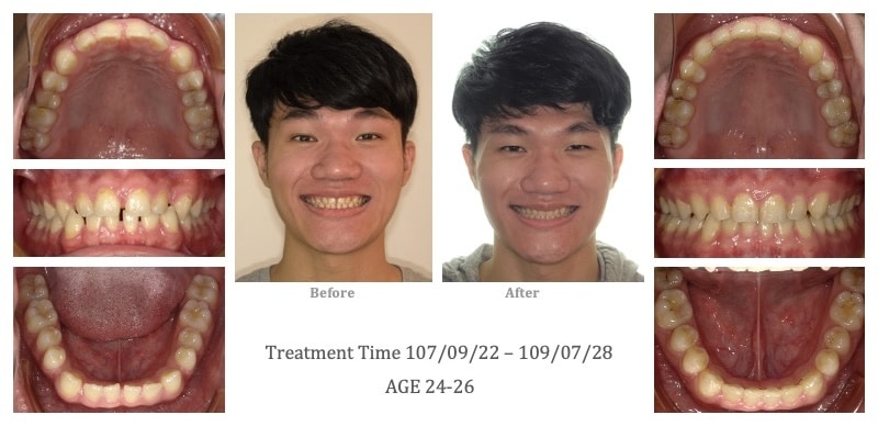 啾啾鞋牙齒矯正前後臉型及咬合變化，矯正後關閉牙齒縫隙，齒列左右對稱且更整齊